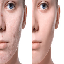 Removal of Acne